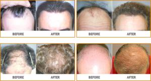 after hair transplant at Kansas City Neograft